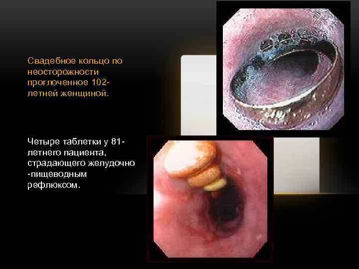 Свадебное кольцо по неосторожности проглоченное 102 летней женщиной. Четыре таблетки у 81 летнего пациента,
