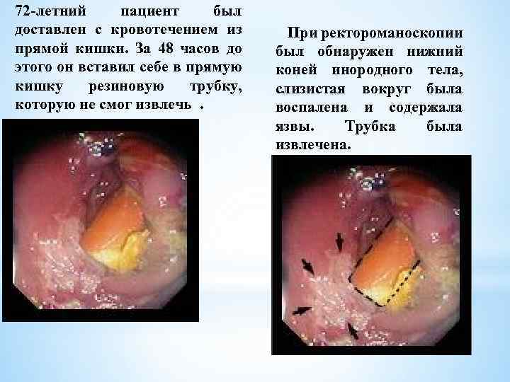 Кровотечение при стуле из прямой кишки