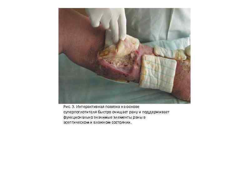 Рис. 3. Интерактивная повязка на основе суперпоглотителя быстро очищает рану и поддерживает функционально значимые