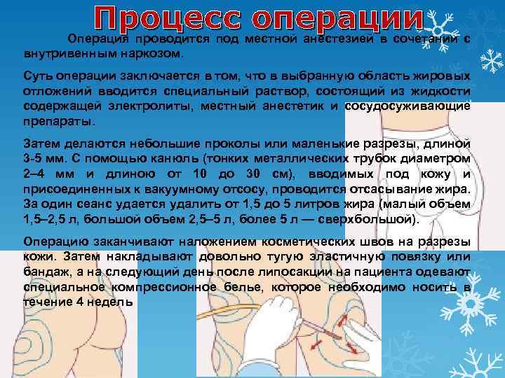 Процесс местной анестезией в сочетании с операции Операция проводится под внутривенным наркозом. Суть операции