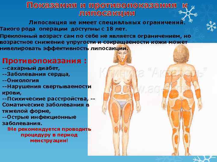 Показания и противопоказания к липосакции Липосакция не имеет специальных ограничений. Такого рода операции доступны