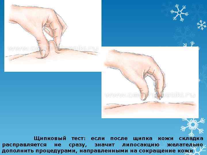Щипковый тест: если после щипка кожи складка расправляется не сразу, значит липосакцию желательно дополнить