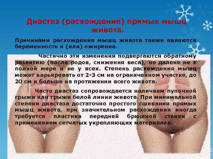 Диастаз (расхождение) прямых мышц живота. Причинами расхождения мышц живота также являются беременность и (или)