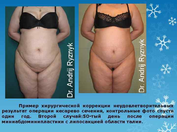 Пример хирургической коррекции неудовлетворительных результат операции кесарево сечения, контрольные фото спустя один год. Второй