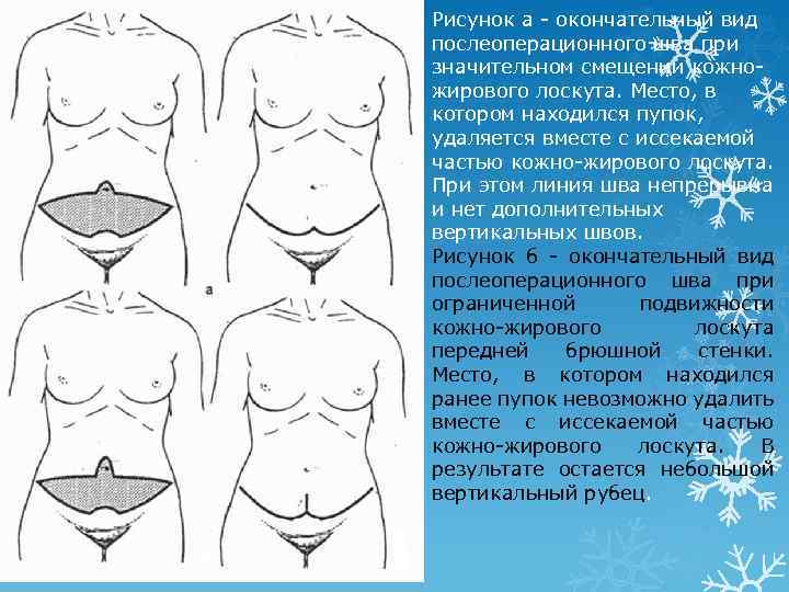  Рисунок а - окончательный вид послеоперационного шва при значительном смещении кожножирового лоскута. Место,