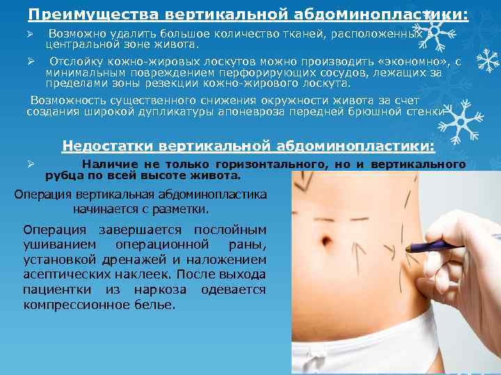 Преимущества вертикальной абдоминопластики: Возможно удалить большое количество тканей, расположенных в центральной зоне живота. Отслойку