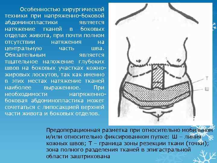  Особенностью хирургической техники при напряженно-боковой абдоминопластики является натяжение тканей в боковых отделах живота,