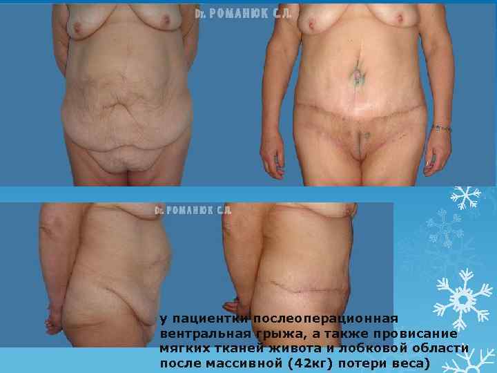 у пациентки послеоперационная вентральная грыжа, а также провисание мягких тканей живота и лобковой области