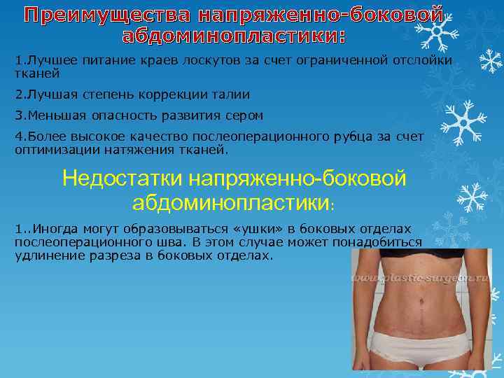 Преимущества напряженно-боковой абдоминопластики: 1. Лучшее питание краев лоскутов за счет ограниченной отслойки тканей 2.