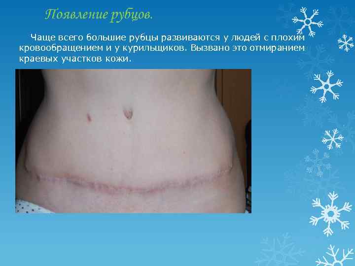  Чаще всего большие рубцы развиваются у людей с плохим кровообращением и у курильщиков.