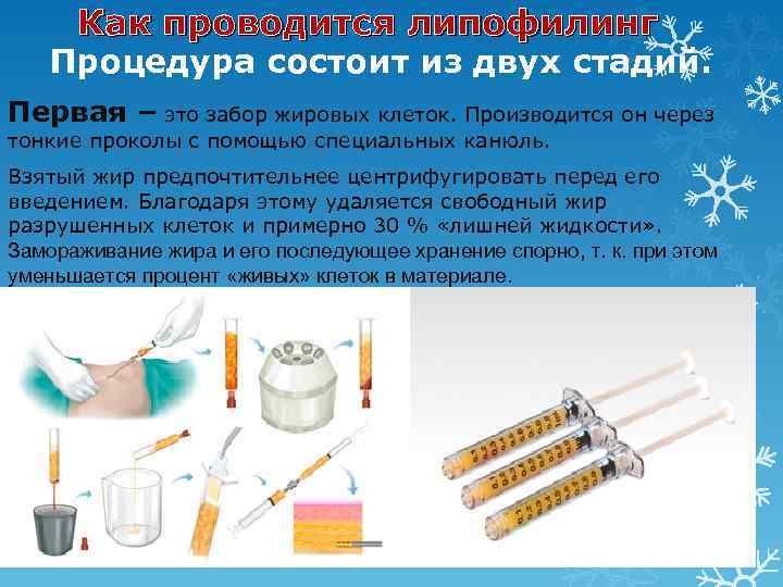 Как проводится липофилинг Процедура состоит из двух стадий. Первая – это забор жировых клеток.