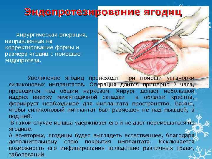 Эндопротезирование ягодиц Хирургическая операция, направленная на корректирование формы и размера ягодиц с помощью эндопротеза.