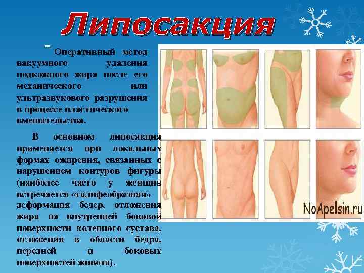 Липосакция - Оперативный метод вакуумного удаления подкожного жира после его механического или ультразвукового разрушения