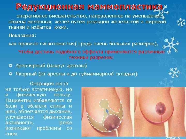Редукционная маммопластика оперативное вмешательство, направленное на уменьшение объема молочных желез путем резекции железистой и