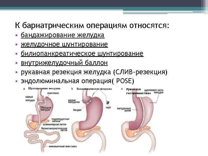 К бариатрическим операциям относятся: • • • бандажирование желудка желудочное шунтирование билиопанкреатическое шунтирование внутрижелудочный
