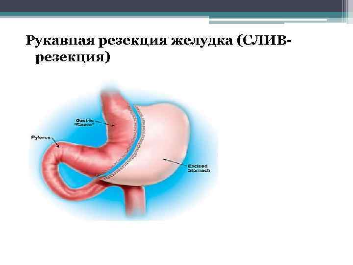 Рукавная резекция желудка (СЛИВрезекция) 