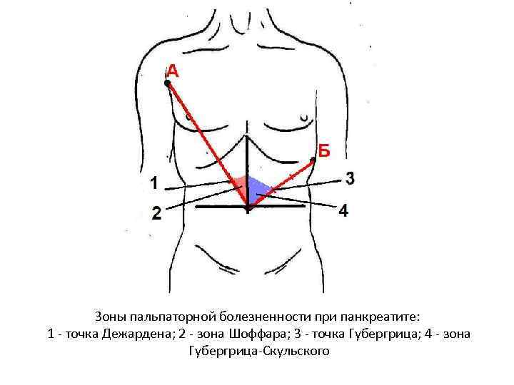 Зоны пальпаторной болезненности при панкреатите: 1 - точка Дежардена; 2 - зона Шоффара; 3