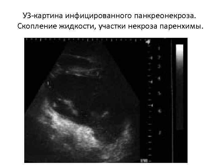 УЗ-картина инфицированного панкреонекроза. Скопление жидкости, участки некроза паренхимы. 