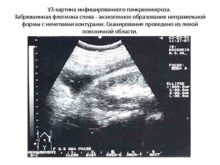 УЗ-картина инфицированного панкреонекроза. Забрюшинная флегмона слева - анэхогенное образование неправильной формы с нечеткими контурами.