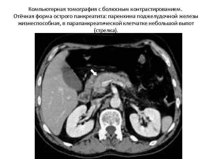 Компьютерная томография с болюсным контрастированием. Отёчная форма острого панкреатита: паренхима поджелудочной железы жизнеспособная, в