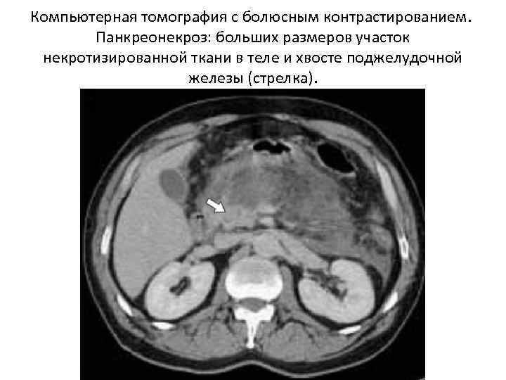 Компьютерная томография с болюсным контрастированием. Панкреонекроз: больших размеров участок некротизированной ткани в теле и