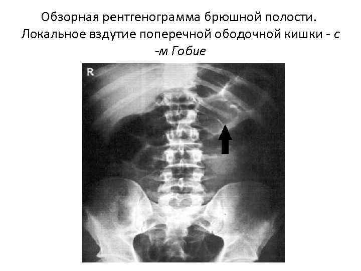 Обзорная рентгенограмма брюшной полости. Локальное вздутие поперечной ободочной кишки - с -м Гобие 
