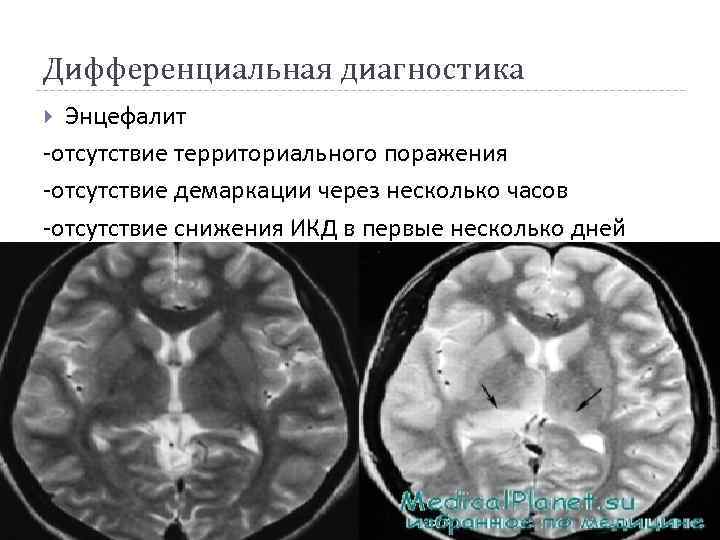 Дифференциальная диагностика Энцефалит -отсутствие территориального поражения -отсутствие демаркации через несколько часов -отсутствие снижения ИКД