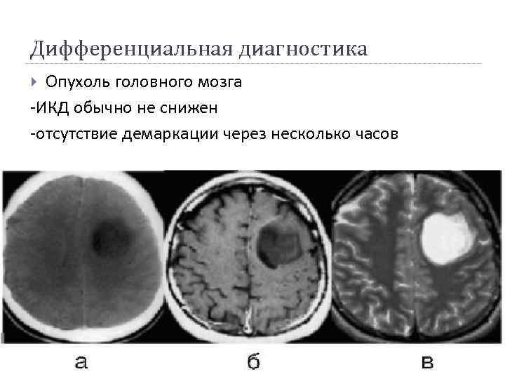 Дифференциальная диагностика Опухоль головного мозга -ИКД обычно не снижен -отсутствие демаркации через несколько часов