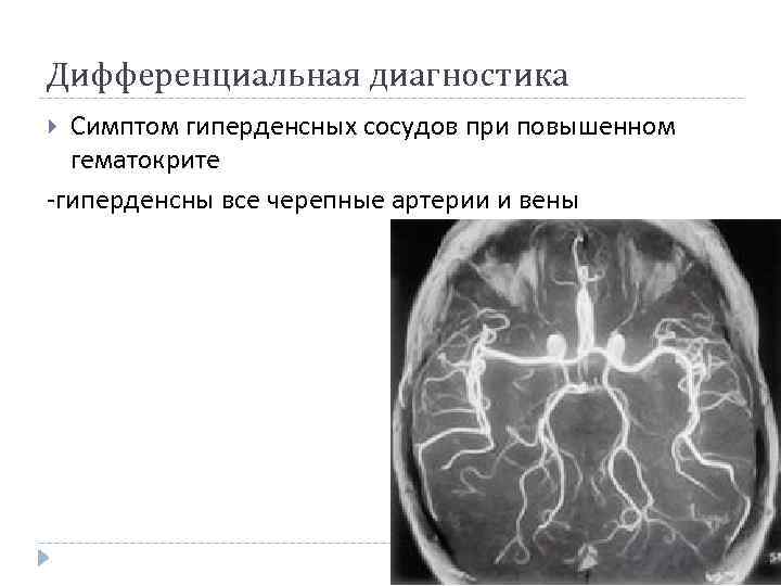 Дифференциальная диагностика Симптом гиперденсных сосудов при повышенном гематокрите -гиперденсны все черепные артерии и вены