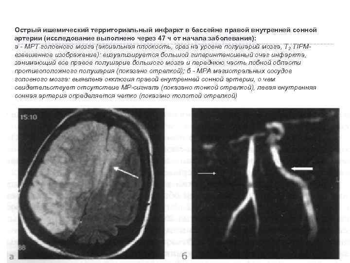 Острый ишемический территориальный инфаркт в бассейне правой внутренней сонной артерии (исследование выполнено через 47