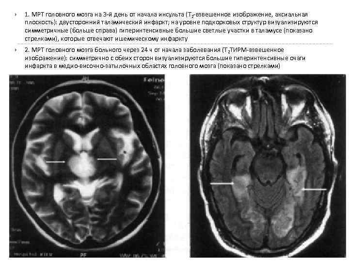  1. MPT головного мозга на 3 -й день от начала инсульта (Т 2