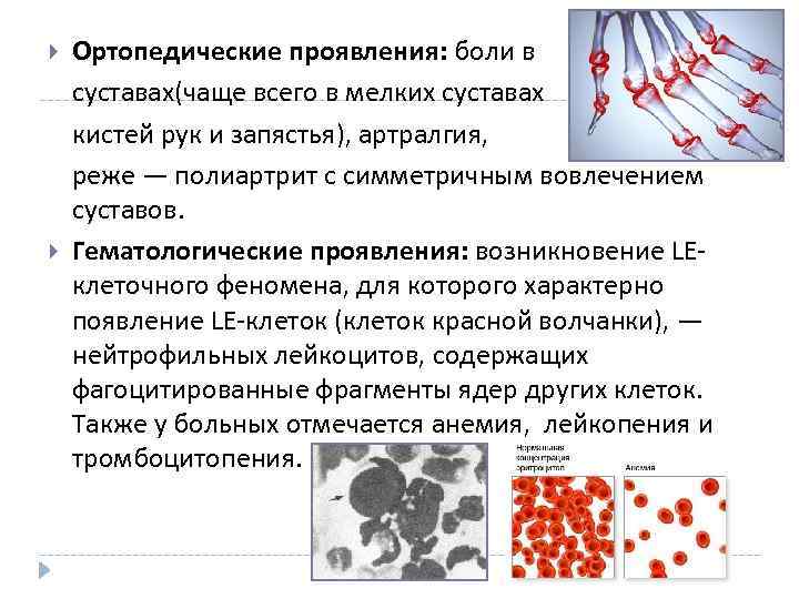  Ортопедические проявления: боли в суставах(чаще всего в мелких суставах кистей рук и запястья),