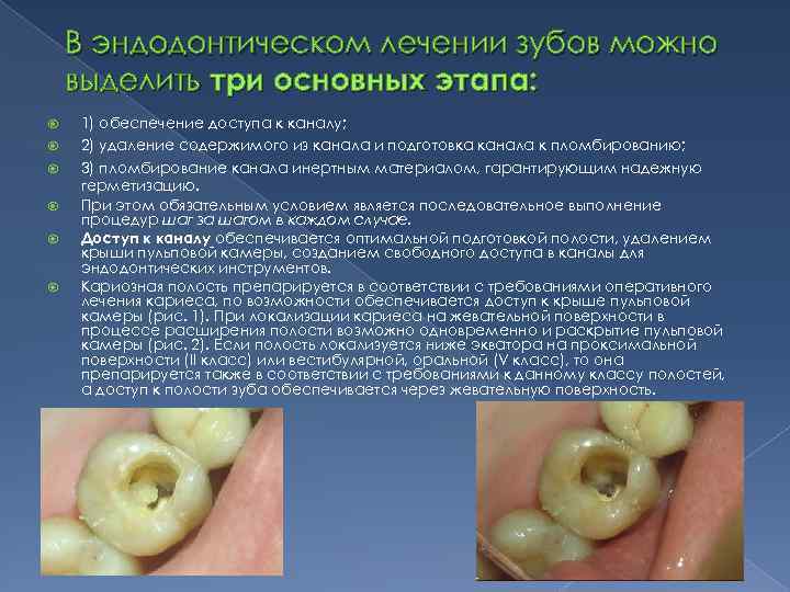 В эндодонтическом лечении зубов можно выделить три основных этапа: 1) обеспечение доступа к каналу;