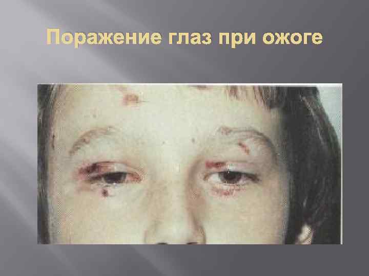 Поражение глаз при ожоге 