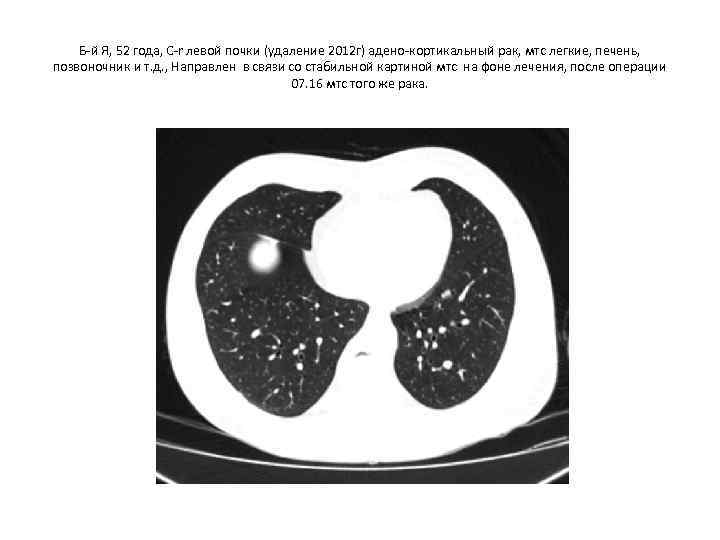 Б-й Я, 52 года, С-r левой почки (удаление 2012 г) адено-кортикальный рак, мтс легкие,