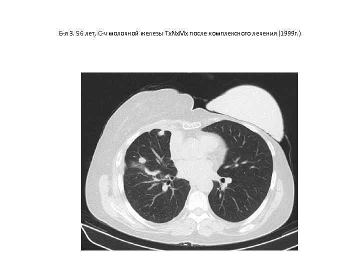 Б-я З. 56 лет, С-ч молочной железы Тх. Nх. Мх после комплексного лечения (1999