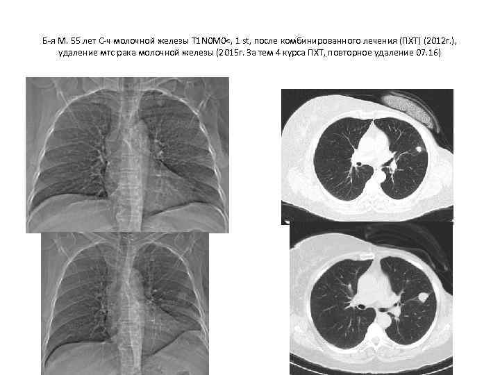 Б-я М. 55 лет С-ч молочной железы Т 1 N 0 M 0<, 1