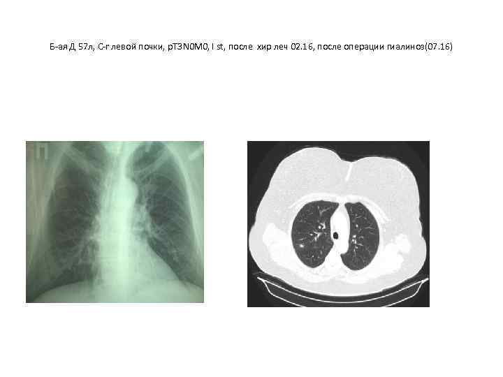 Б-ая Д 57 л, C-r левой почки, р. Т 3 N 0 M 0,