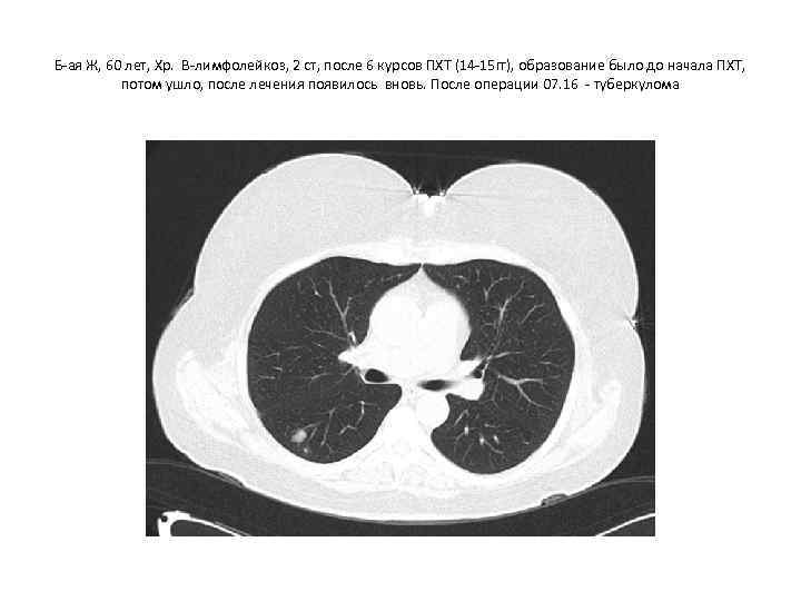 Б-ая Ж, 60 лет, Хр. В-лимфолейкоз, 2 ст, после 6 курсов ПХТ (14 -15