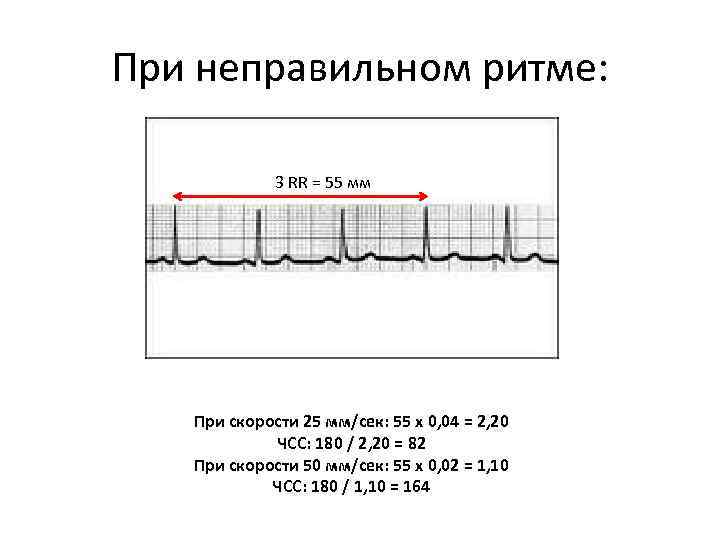 Как измерить частоту сердечных. Подсчет ЧСС на ЭКГ 50 мм/с. Формула ЧСС по ЭКГ 25 мм. Подсчет ЧСС на ЭКГ 25 мм/с. ЭКГ расчет ЧСС 50 мм.