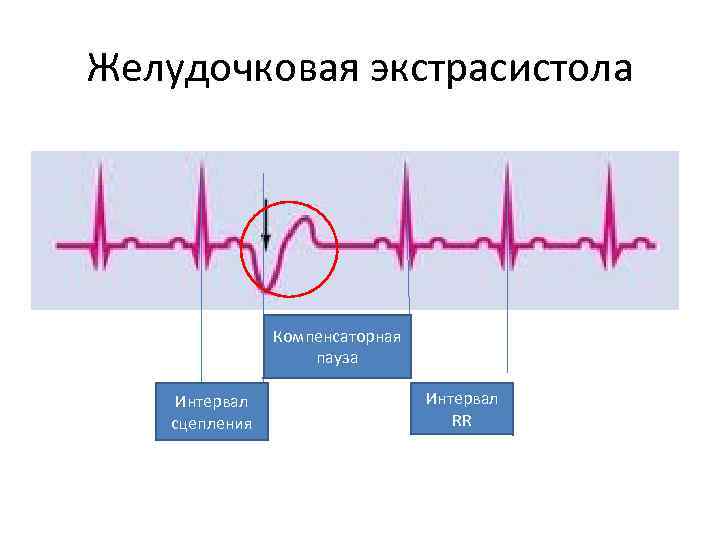 Желудочковая экстрасистола Компенсаторная пауза Интервал сцепления Интервал RR 