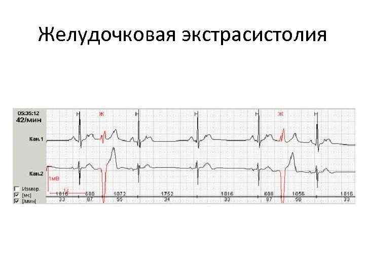 Желудочковая экстрасистолия 