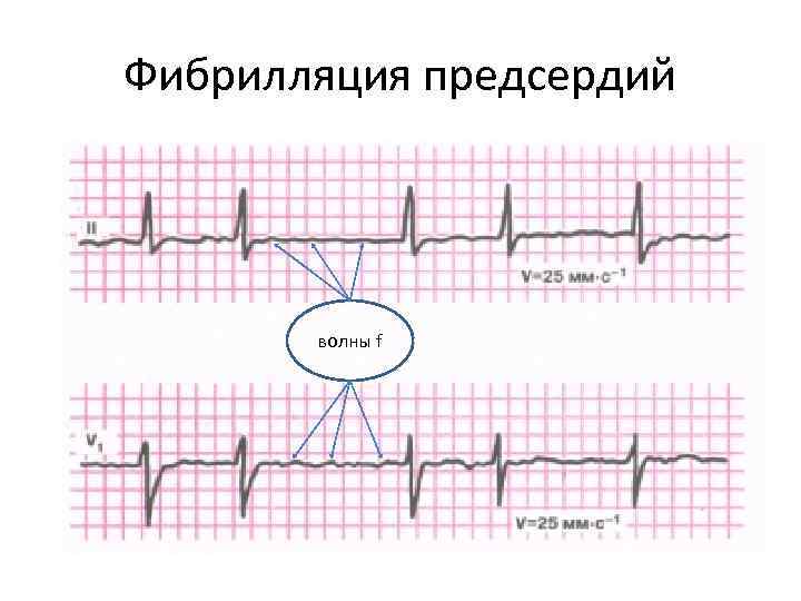 Фибрилляция это. Волны f при фибрилляции предсердий. Трепетание предсердий волны f. Фибрилляция предсердий это нарушение проводимости. Волны трепетания f.