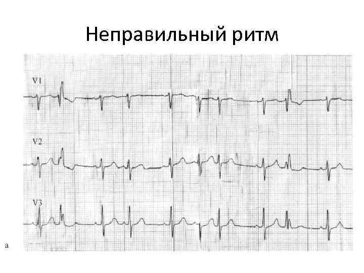 Правильный ритм. Неправильный ритм на ЭКГ. Неправильный ритм сердца на ЭКГ. Правильный неправильный ритм ЭКГ. ЭКГ неправильный ритм пример.