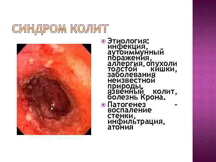  Этиология: инфекция, аутоиммунный поражения, аллергия, опухоли толстой кишки, заболевания неизвестной природы, язвенный колит,