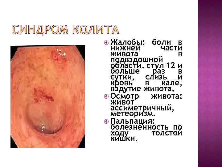  Жалобы: боли в нижней части живота в подвздошной области, стул 12 и больше