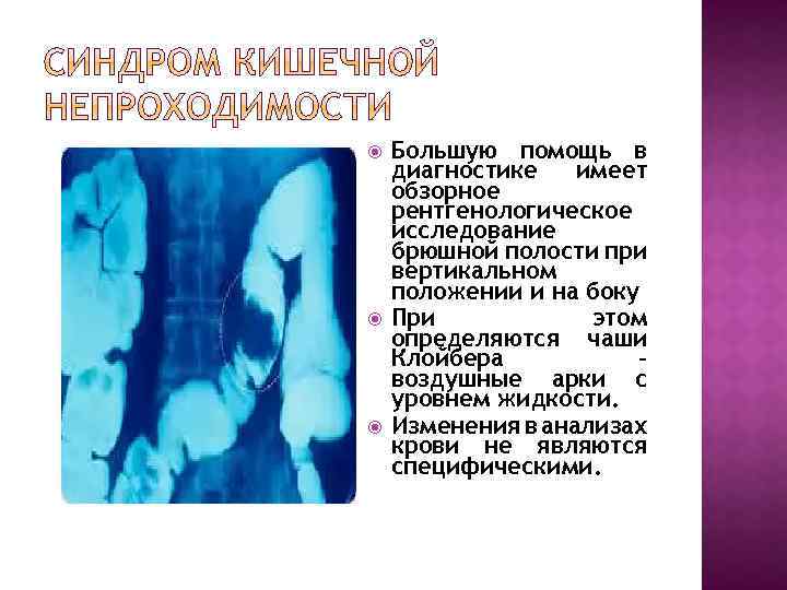  Большую помощь в диагностике имеет обзорное рентгенологическое исследование брюшной полости при вертикальном положении