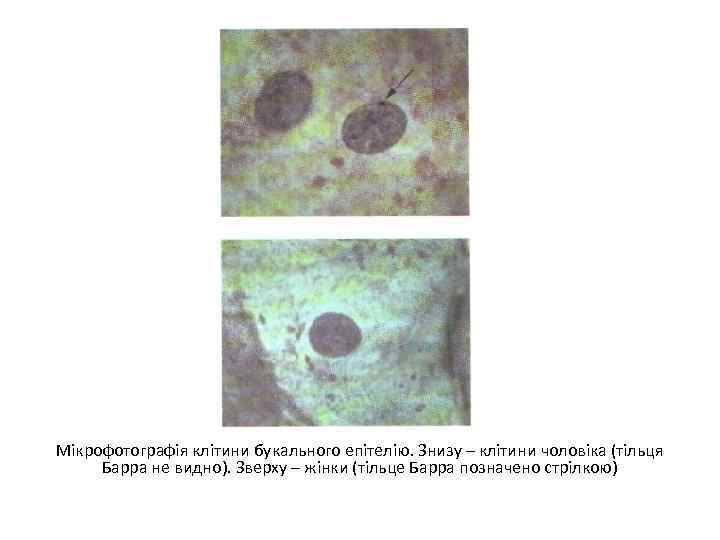 Мікрофотографія клітини букального епітелію. Знизу – клітини чоловіка (тільця Барра не видно). Зверху –