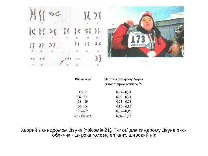 Вік матері Частота синдрому Дауна у новонарожденных, % 15 -19 20— 24 25— 29