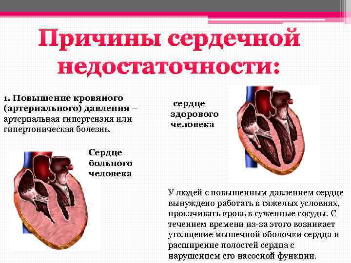 Гипертензивное поражение сердца. Артериальное давление при острой сердечной недостаточности. Сердечная недостаточность при поражении миокарда. Гипертоническая болезнь сердца сердечная недостаточность. Гипертензивная болезнь сердца патология.